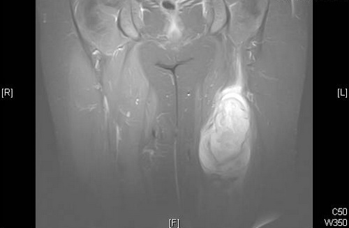 45++ Morbus sudeck mrt bilder , 30jährige Patientin mit Raumforderung im rechten Musculus psoas el