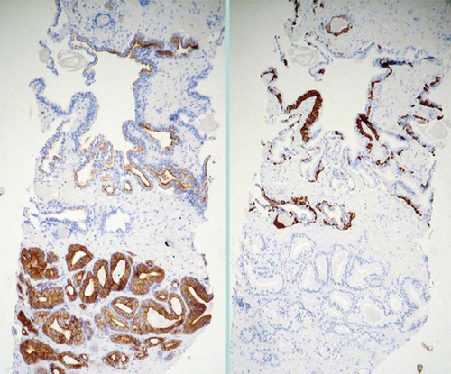 prostatakarzinom histologie)